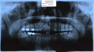Wisdom Teeth Removal Indianapolis X-ray