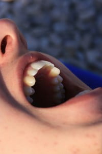 Better Dental Implants