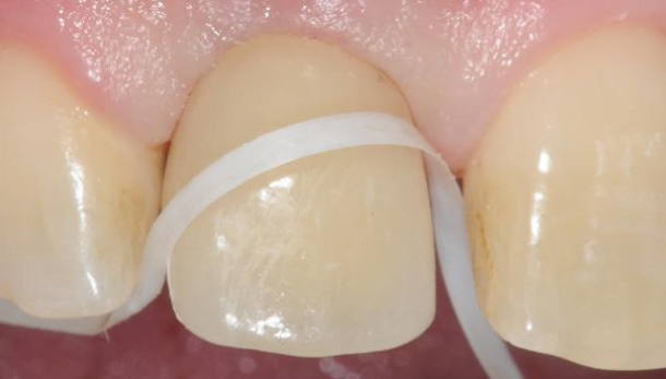 dental implants noblesville indiana maintenance