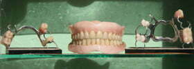 full prosthesis Indianapolis