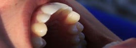 Better Dental Implants