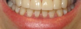 Veneers Indianapolis