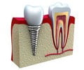 anatomy of dental implants Indianapolis